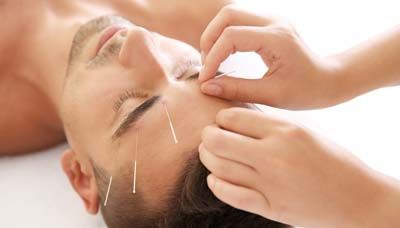 Aculifting acupuncture